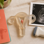 Polype utérus : maquette et échographie pour diagnostic et signes d’alerte